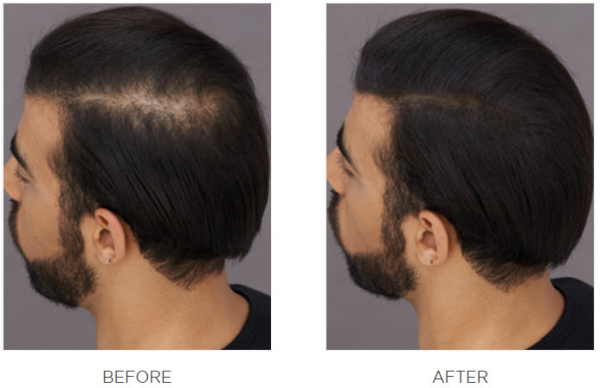 hair-fibers-before-after-toppik