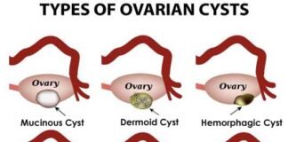 types-of-cysts